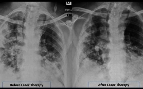 Biosana - Terapia laserom s MLS ® žiarením vykazovala výrazné zlepšenie stavu pacienta.